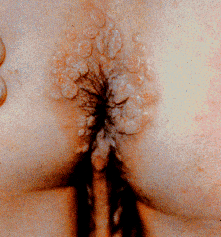 photo: the Genital Warts Solution